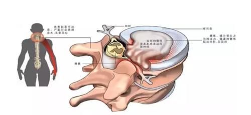 颈椎病|脖子不痛，也可能有颈椎病！出现这些征兆要警惕！