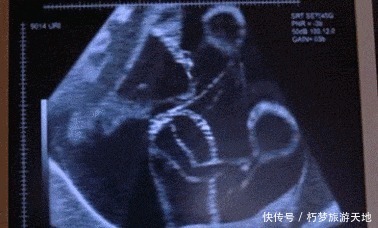 巧合|白天安静,晚上胎动频繁,胎儿生物钟乱了吗宝宝不舒服还是巧合