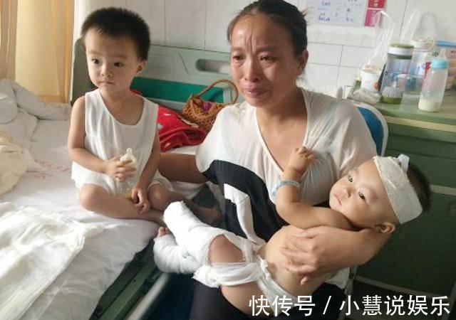 常识|孩子烫出水泡,要不要刺破烫伤高发期,基本急救常识要知道