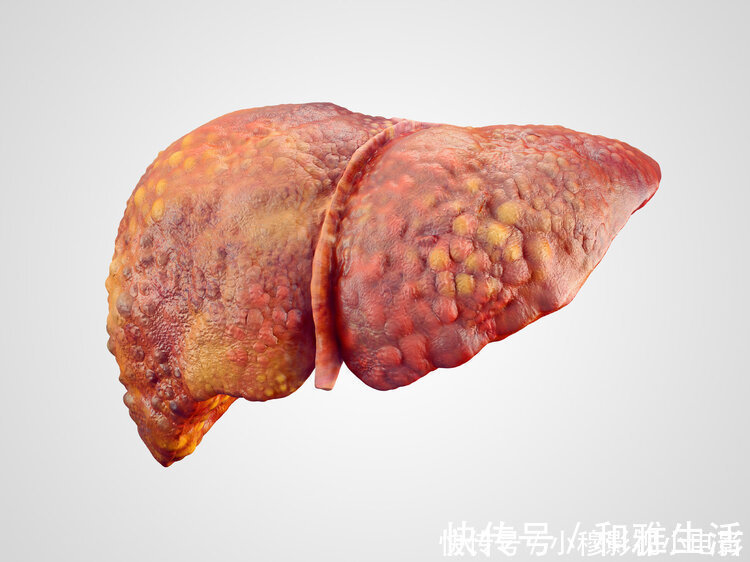 预防肝硬化|重视:除了皮肤小红点,身体出现4个异常,可能是肝硬化“敲门”