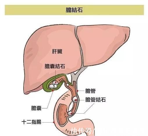 ct|男子腹痛、黄疸，以为结石手术，打开腹腔医生感慨:肿瘤转移了!