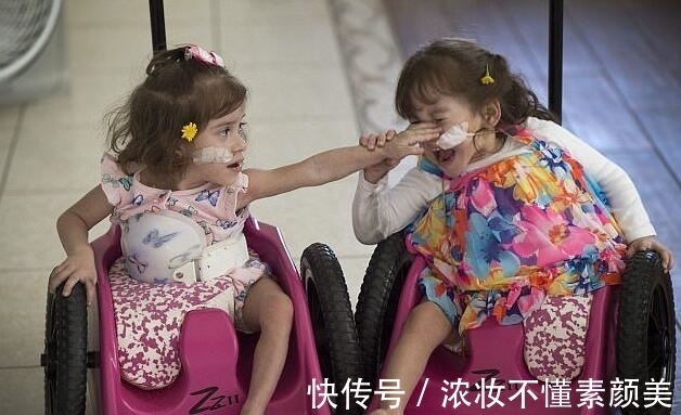 双胞胎|连体双胞胎做分离手术成功,每人分得一条腿,父母喜极而泣!