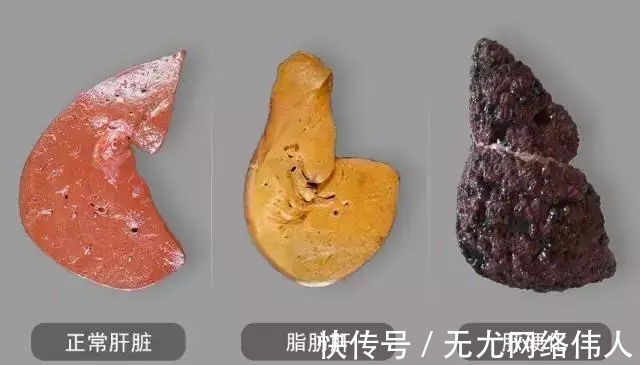 肝硬化|92岁退休主任：常用“1素”煮水喝，摘掉多年肝病“帽子”