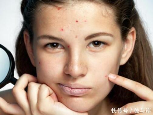 长痘怎么预防留痘印？做好7件事很重要！一定不可忽视