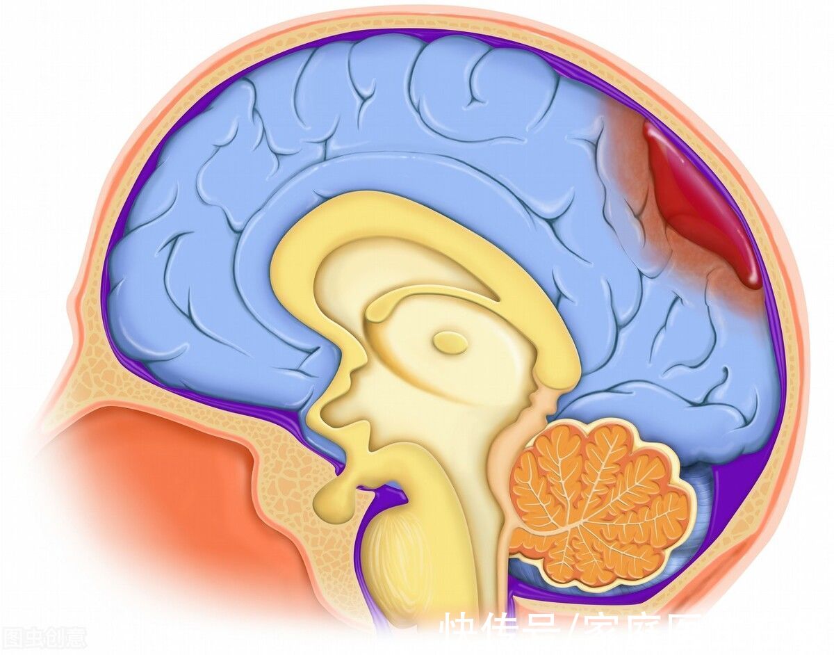 年轻人|脑出血是老年人的“专属”？它盯上年轻人了，想预防要牢记这几点
