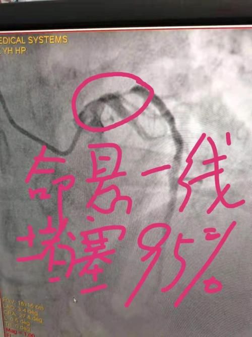 48岁男子3个错误致命悬一线！医生不等家属到，全力抢救成功！