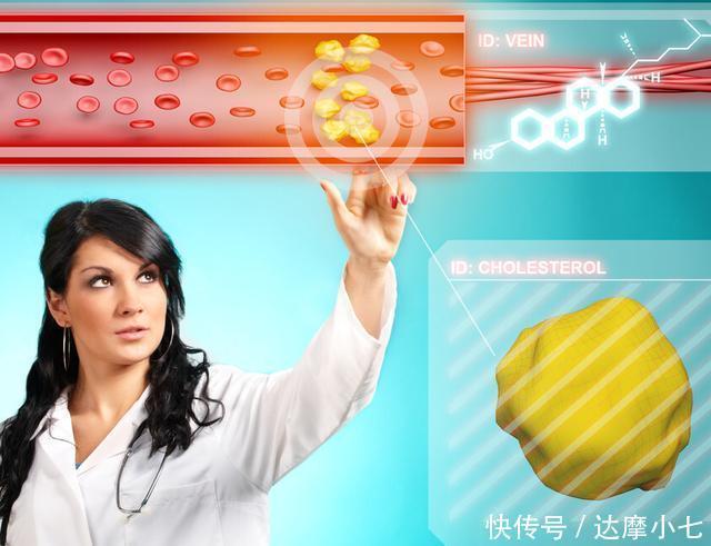 胆固醇|胆固醇“喜欢”一种食物,偶尔来一点,高血脂或许悄悄走了