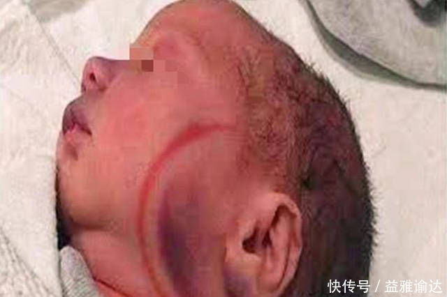 小刘|1岁宝宝“产钳印”未消退,宝妈上医院讨说法,医生的话让她羞愧