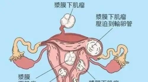 化瘀散结|子宫肌瘤3大形成原因:炎、寒、气!中医1招,化瘀散结,彻底降服