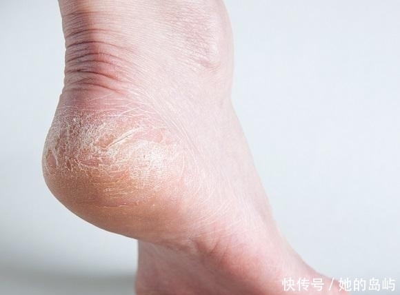 脚后跟|肾好不好要看脚,脚上若没有出现这3种情况,说明你的肾很健康!