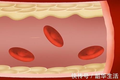 血小板|经常吃洋葱的人,体内不易出现血栓?是真的吗?专家说得很有道理