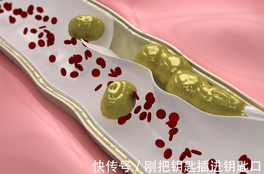 脑梗|血栓什么时候掉下来，大脑就什么时候瘫痪养血管，牢记3件事