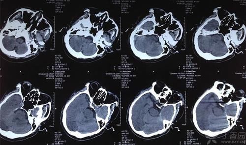 刘大爷|70多高血压大爷擅自“换药”,换出脑出血,“药”不能随便换