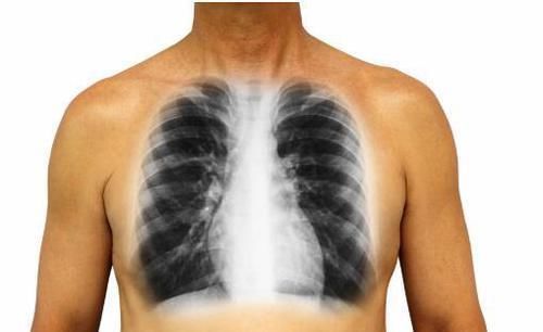 肺癌|肺癌到了晚期,4个变化很明显,骗不了人,别大意了