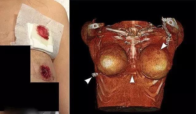 隆胸硅胶假体还能防弹一女子枪口下幸存,医生看完一脸懵