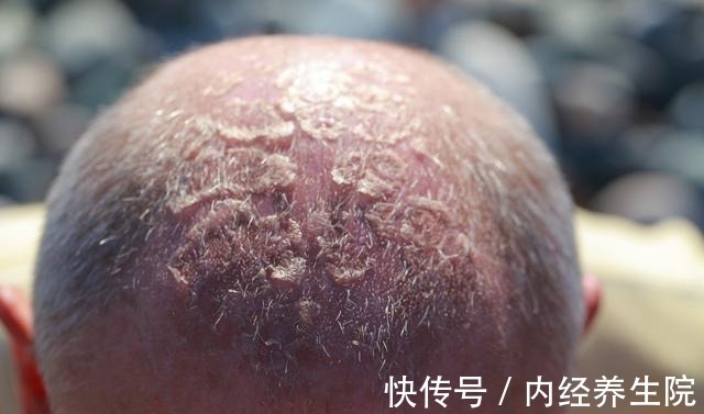 头皮 身体的防晒霜能直接涂在头皮或头发上吗!