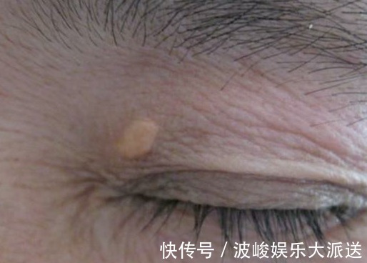 ep血脂高不高,看脸上三个地方就知道,降血脂四种食物一口别吃