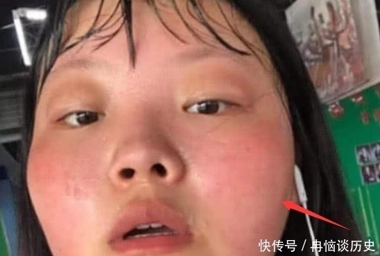 油光满面|青春期女生脸上总是“油光满面”?坚持“3习惯”,帮你缓解“大油田”