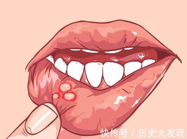 病原體|口腔潰瘍是上火嗎？這三個真相你應該了解