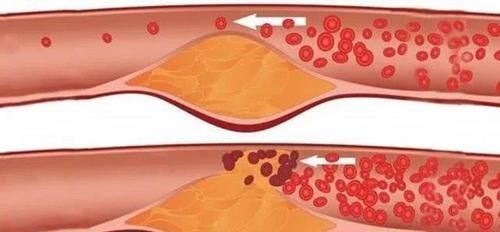 常吃|高血脂的“天敌”已找到，常吃清理血管垃圾，血脂悄悄往下降