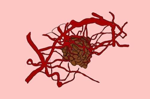 癌症患者|“癌中之王”胰腺癌,发现到死亡有的只需半年,如何提高生存率?