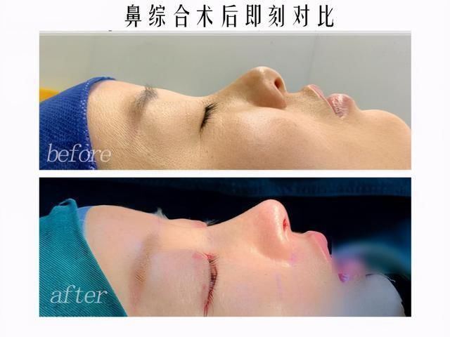 隆鼻|知名女星惊现“女巫鼻”天价隆鼻就能整出好鼻子