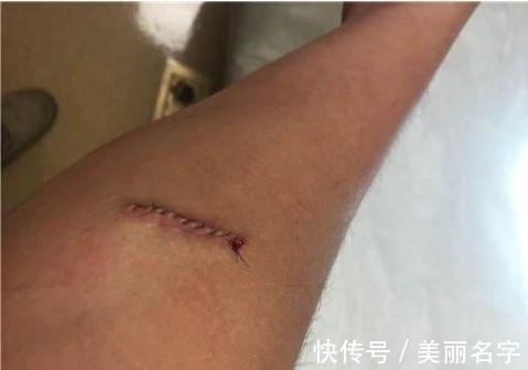 手臂|男子手臂有小肿块未在意,感觉疼痛后就医,取出的东西令人不冷静