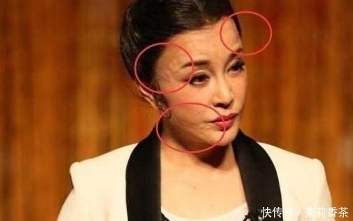 鼻梁|长期注射玻尿酸的人,皮肤会撑开变松弛?专业整形顾问告诉你