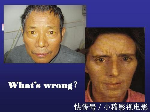 酒水|48岁男子查出肝硬化,医生:3种食物伤肝不浅,尽量少食