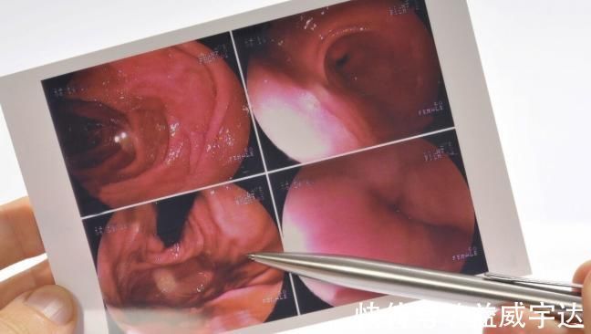 上皮内瘤变|胃镜查出来“上皮内瘤变”，是癌吗？该怎么办？