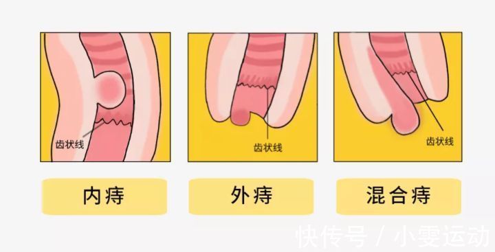 肉球|怎么让脱出的痔疮肉球缩回?四个小窍门,或能消除痔疮肉球!