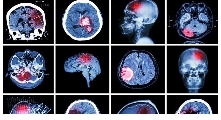 脑出血|35岁男子晨跑猝死，了解病史后，医生叹息：高血压最忌一件事