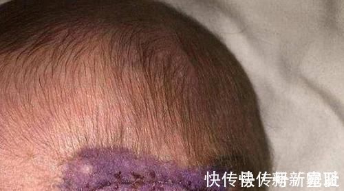 剖腹产|剖腹产划伤孩子头部,医生很快就会好的,7年后家长找上医院