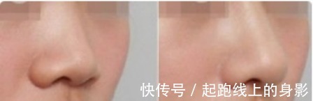 风险 鼻炎能做隆鼻手术吗隆鼻之后会有哪些术后风险!