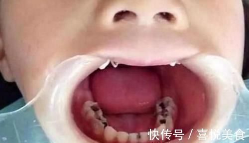 惹的祸|3岁的孩子满口“小黑牙”?罪魁祸首不是糖,而是父母无知惹的祸