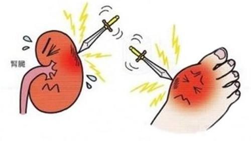 尿酸高的人，若身体出现这3种现象，已经影响肾脏，平常多做这3点