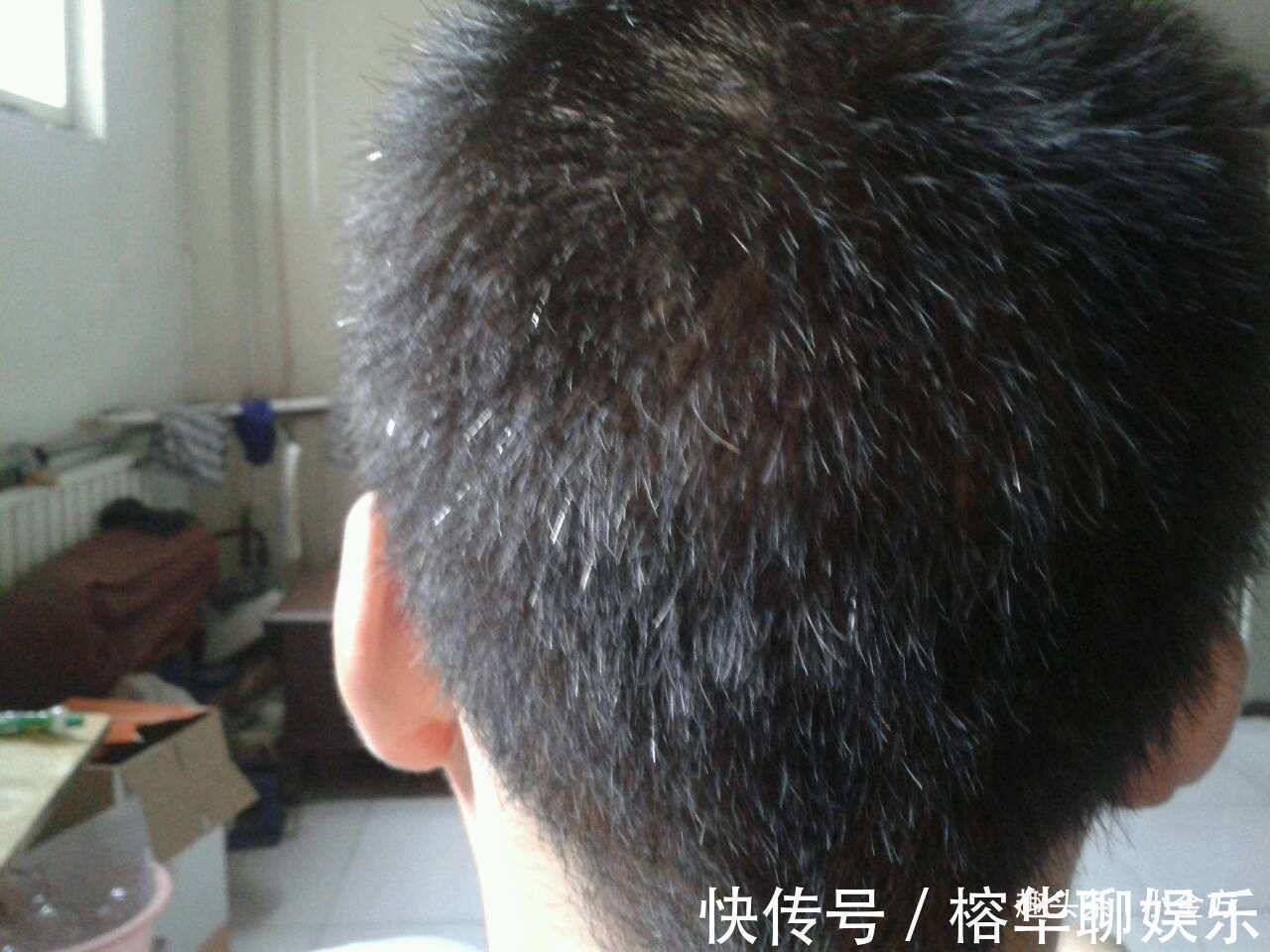 两鬓|两鬓白发、前额白发、后脑白发3个地方有白发，一次讲清楚！