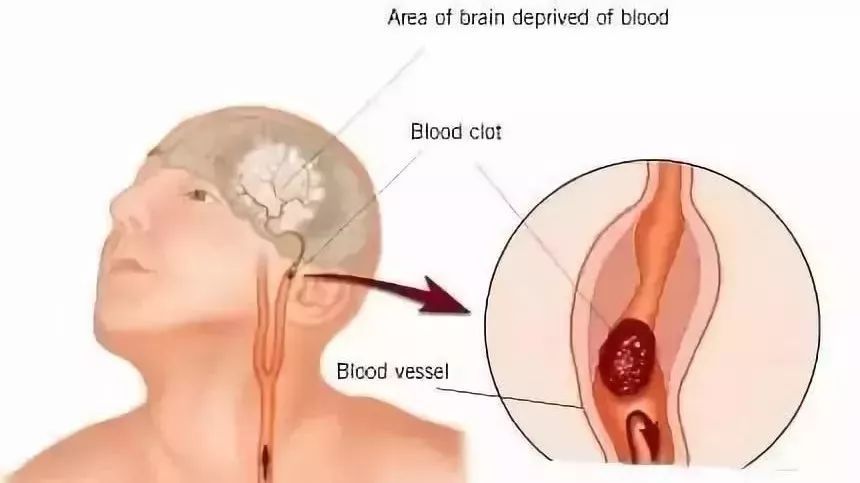 血液|德国颠覆性研究：动脉硬化斑块并非来自血液中的脂肪