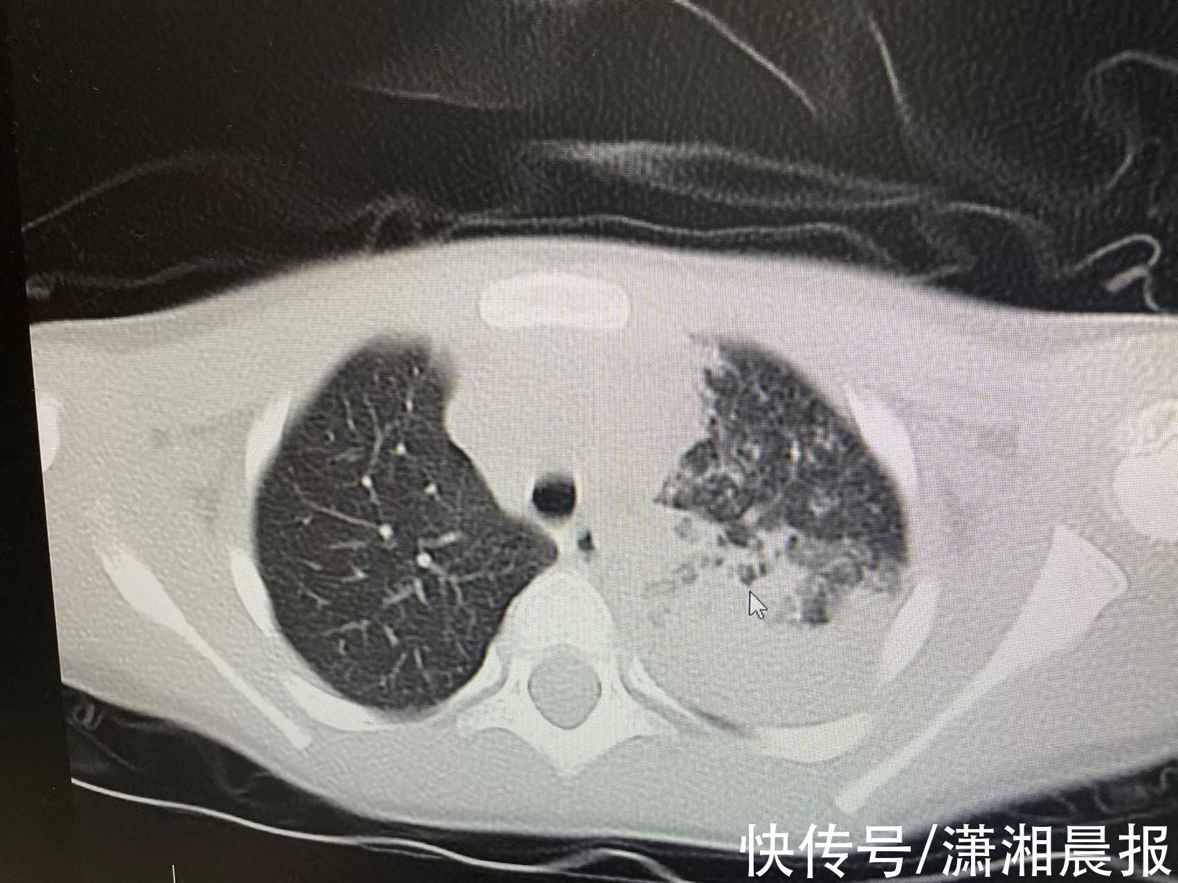 支原体|咳嗽发烧不一定是感冒，同样症状这种病延误会危及生命