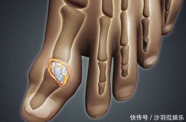 降尿酸的神器公布,苏打水并不排首位,敞开喝,尿酸回归正常