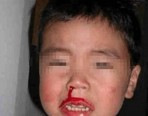 乐乐|4岁男孩鼻血不止，送医院被告知“无法抢救”，只因宝妈这一举动