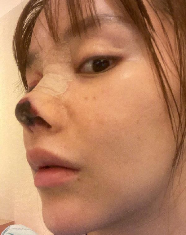 24岁女星整容鼻尖坏死 职业生涯被毁还搭上200万 医生仅罚4万9