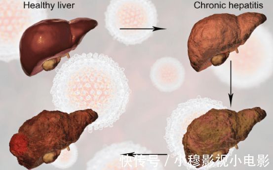 肝癌|39岁男子,被查出肝癌,抱头痛哭,医生叹息:这“3”种习惯,是祸根