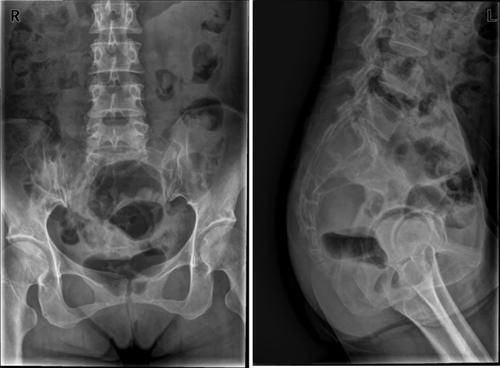 椎体|脊柱常见肿瘤及肿瘤样病变的几种影像学表现，你都见过吗？