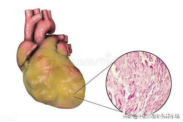 降脂|既能抗凝又能降脂稳定斑块？聊一聊常用的中成药——通心络胶囊