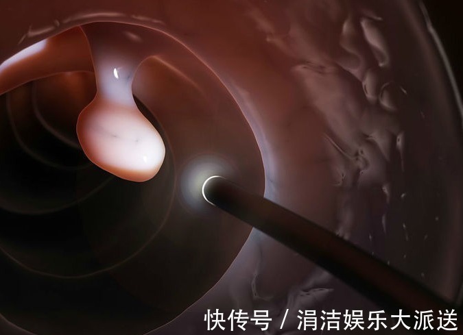恶性肿瘤|两种息肉一定要及时切除,拖五年以上很可能变成恶性肿瘤