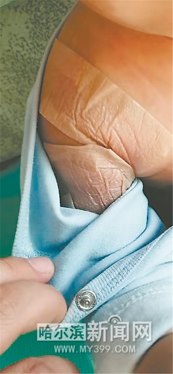 小喆目前|被烫伤的婴儿小喆出院了