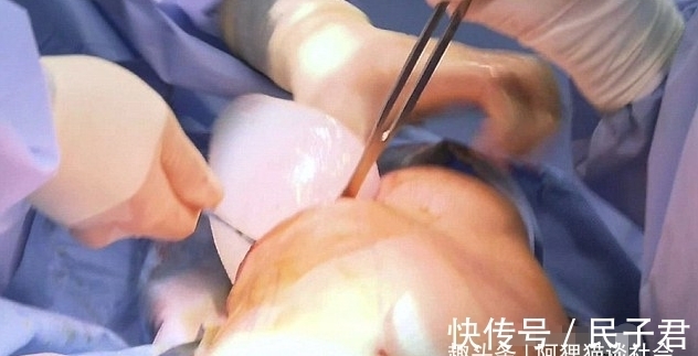 翅膀 男子花200万植入翅膀，接受120次整容手术，现与“芭比娃娃”相爱