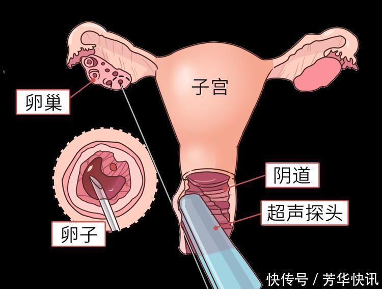 卵巢|女大学生“捐卵”还贷过程曝光,一次赚3.5万,最后肠子悔青了