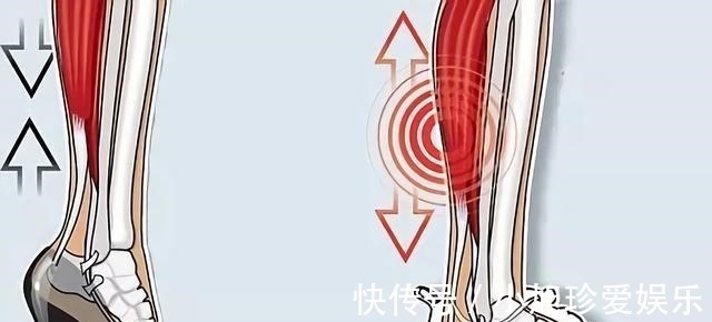 拇囊炎|穿高跟鞋的危害到底有多大?